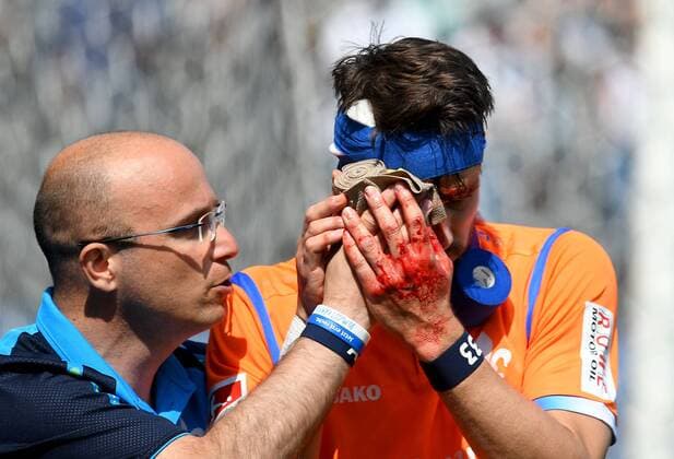 21 04 2018 xfux Football 2 Bundesliga SV Sandhausen SV Darmstadt 98 emspor emonline v team doctor Dr Alexander vfLesch SV Darmstadt 98 Romain Bregerie SV Darmstadt 98 receive an injury bruise harried hurt injured injury trauma disappointed crestfallen injured injury blood bleeding red blood on Sandhausens face