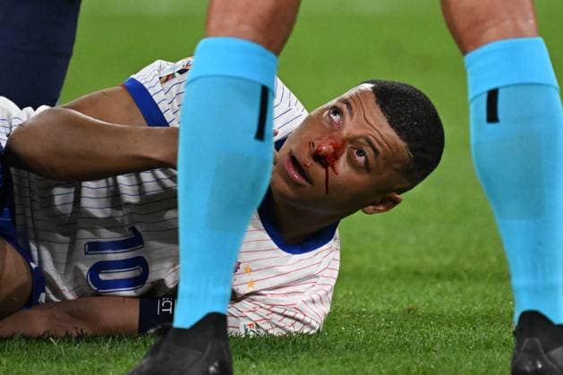 17 06 2024, xjhx, Football EM 2024, Austria France emspor, v l Kylian Mbappe Lottin France with pain, injured, injury bleeding nose nosebleed DFL DFB REGULATIONS PROHIBIT ANY USE OF PHOTOGRAPHS as IMAGE SEQUENCES and or QUASI VIDEO Düsseldorf