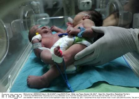 Bilder des Tages October 22, 2017 - Gaza City, Gaza Strip, Palestinian Territory - One-day-old Palestinian conjoined twins boys (Siamese twin) from the Ghanem family with one body but two heads, lie in an incubator at the neonatal intensive care unit at Shifa hospital in Gaza city on October 22, 2017. Conjoined twins occur around once in every 200,000 live births. The survival rate is usually between five and 25 percent, doctors say. Around 70 percent of all conjoined twins are girls Gaza City Palestinian Territory - ZUMAap3_ 20171022_zaf_ap3_016 Copyright: xMohammedxAsadx