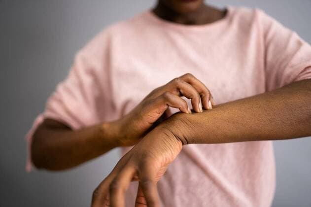 African American Woman With Itchy Skin, African American Woman With Itchy Skin. Allergy Or Psoriasis model released, Symbolfoto , 04.09.2021, Copyright: xAndreyPopovx Panthermedia30701854.jpg