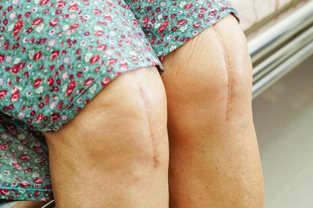 Asian elderly woman patient with scar knee replacement surgery in hospital., Asian elderly woman patient with scar knee replacement surgery in hospital., Asian elderly woman patient with scar knee replacement surgery in hospital., 13.08.2022, Copyright: xsweettomatox Panthermedia31703504.jpg