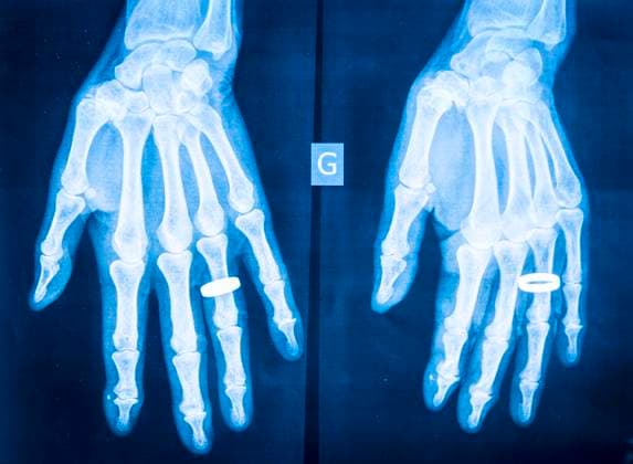 X-ray of rheumatism in the hands. Rheumatism 013843_010