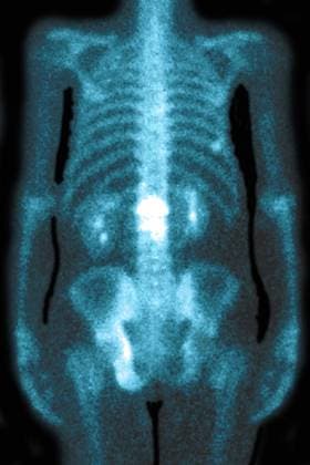Lumbar osteoporosis (disease causing compression and fractures of the lumbar vertebrae). X-ray of the lumbar vertebrae seen from the front. Lumbar osteoporosis. 016836_038