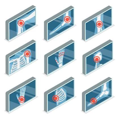 3D Isometric Flat Set of Images of Human Joints , Arthritis and Osteoporosis<br>3D Isometric Flat Set of Images of Human Joints , Arthritis and Osteoporosis 3D Isometric Flat Set of Images of Human Joints , Arthritis and Osteoporosis 3D Isometric Flat Set of Images of Human Joints , Arthritis and Osteoporosis Copyright: xZoonar.com AnastasiiaxTorianykx 22295764