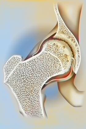 Hip osteoarthritis (femoral head and acetabulum). The cartilage at the femoral head and acetabulum is worn, osteophytes (bony growths) have formed. Bone tissue remodeling also occurs: at the friction regions, bone condensation occurs (osteocondensation) while geodes (cavities) form in the contiguous areas. See images 1531507 for the coxofemoral joint without pathology, 1531707 for osteoporosis and femoral neck fracture. Hip osteoarthritis drawing 016238_051