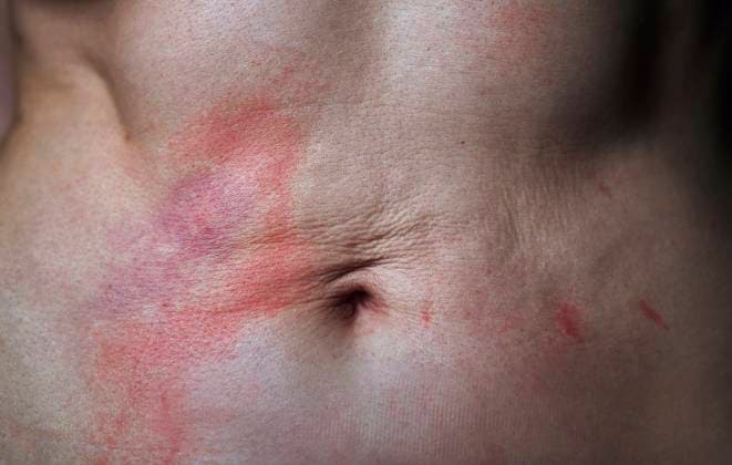 Close up of abdomen with psoriasis redness irritation and scar tissue model released, Symbolfoto, AZF00697