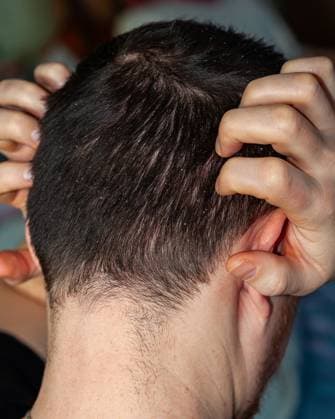 Nahaufnahme von dunklem, von Schuppen befallenem Haar, die ein häufiges Kopfhautproblem verdeutlicht. Close-up shot of a person with dark hair and visible dandruff on their scalp, emphasizing the issue of scalp health and common skin condition. (License=RF) ,model released, Symbolfoto Copyright: xZoonar.com AndriixAbryutinx 24044378 ,model released, Symbolfoto ,property released