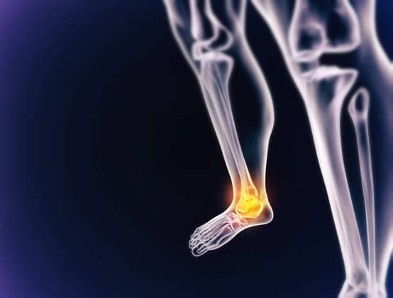 A cgi view of an inflamed joint isolated on blue (License=RF) ,model released, Symbolfoto  Copyright: xZoonar.com YurixArcursx 18230457 ,model released, Symbolfoto ,property released