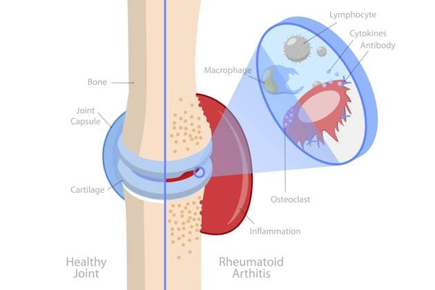Isometrische flache konzeptionelle 3D Illustration von rheumatoider Arthritis, Knochenschmerzen, Verletzungen und Entzündungen 3D Isometric Flat Conceptual Illustration of Rheumatoid Arthritis, Bones Pain, Injury and Inflammation Copyright: imageBROKER AnastasiiaxTorianyk ibxplw17857855.jpg