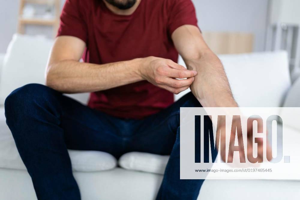Man With Itchy Skin, Man With Itchy Skin. Allergy Or Psoriasis, Man With Itchy Skin. Allergy Or Psoriasis model released, Symbolfoto , 09.09.2022,