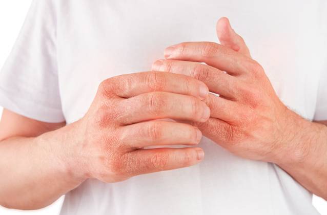 Mann kratzt oder zeigt Hände mit trockener, rissiger Haut auf weißem Hintergrund. Problem mit vielen Menschen - Ekzem auf der Hand, Allergien oder trockene Haut. Konzept der Gesundheitsfürsorge. Nahaufnahme. Man scratches or shows hands with dry, cracked skin on white backgrounds. Problem with many people - eczema on hand, allergies or dry skin. Health care concept. Close up. (License=RF) Copyright: xZoonar.com KatsiarynaxHuravax 23357550