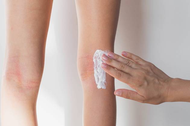 Mutter schmiert ihrer 7-jährigen Tochter die gerötete Haut unter den Knien mit einer speziellen Feuchtigkeitscreme für atopische Haut ein, juckende Flecken von atopischer Dermatitis, ihr Gesicht ist nicht zu sehen, Nahaufnahme mother smears her 7 year old daughter s red skin under the knees with a special moisturizing cream for atopic skin, itchy spots of atopic dermatitis, their faces are not visible, close-up. (License=RF) Copyright: xZoonar.com EvgeniiaxGordeevax 23508160