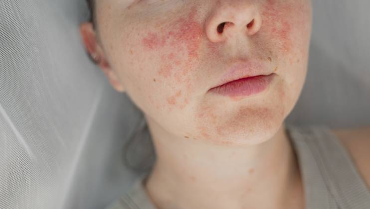 Nahaufnahme einer jungen Frau mit sichtbarer Rötung, Irritation und entzündeter Textur der Gesichtshaut. Konzept von Hautpflegeproblemen und dermatologischer Behandlung. Natürliche Hautunreinheiten, Schönheit und Gesundheit Close-up young woman with visible facial skin redness, irritation, and inflamed texture. Concept of skincare problems and dermatology treatment. Natural skin imperfections, beauty, and healthcare Copyright: imageBROKER AlinaxKandybka ibxayk18765465.jpg ,model released, Symbolfoto ,property released